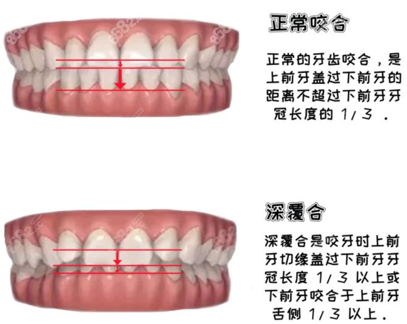 什么是深覆合？深覆合图片展示