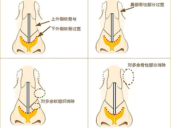 宽鼻矫正手术过程鼻骨内推