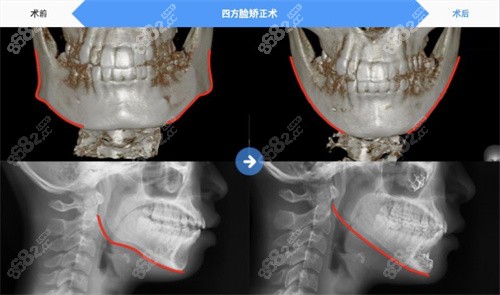 韩国必妩整形外科医院四方脸矫正照片