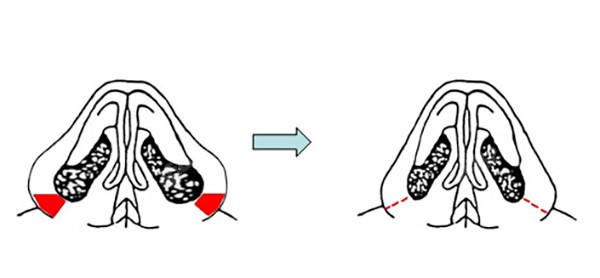 宽鼻矫正手术过程缩鼻翼