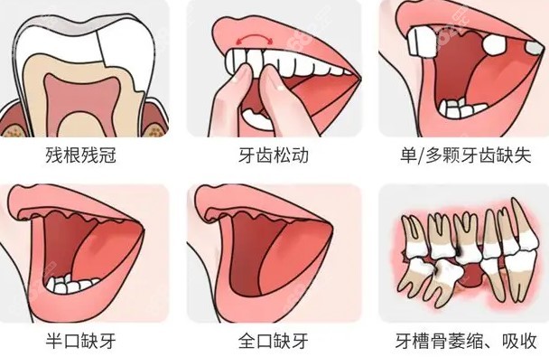 滁州全口种植牙哪家好？m.8682.cc