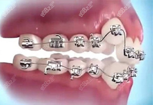 金属钢牙套价格www.8682.cc 金属钢牙套价格www.8682.cc