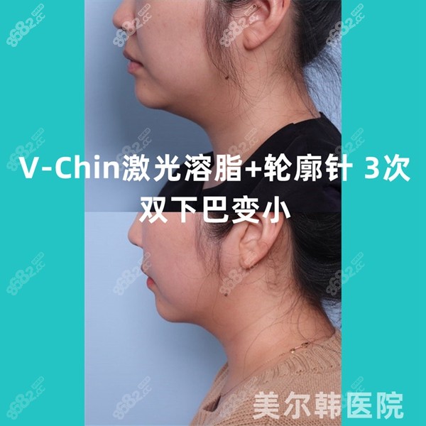 韩国美尔韩医院做V-Chin双下巴轮廓激光 8682.cc