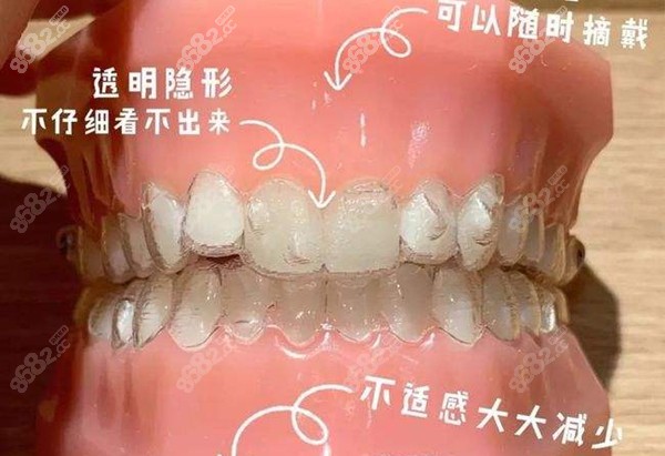 隐形牙套的优缺点 隐形牙套的优缺点