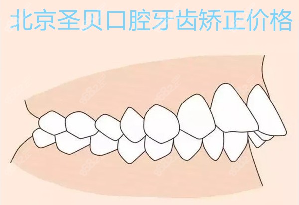 北京圣贝口腔牙齿矫正价格:含金属托槽及隐形矫正多少钱