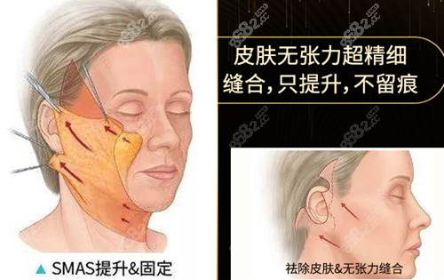 黄广香拉皮除皱优势