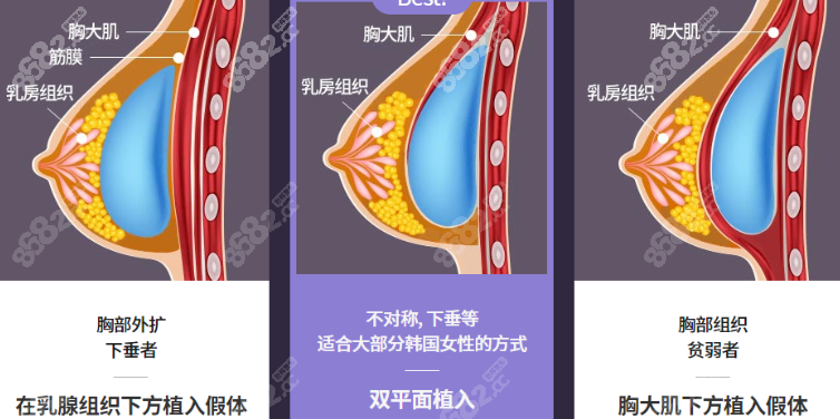 双平面隆胸技术