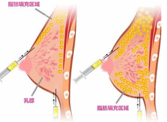 隆胸手术