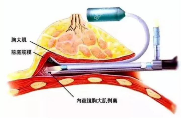 隆胸医生免费问诊