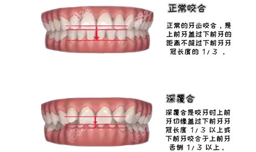 深覆合