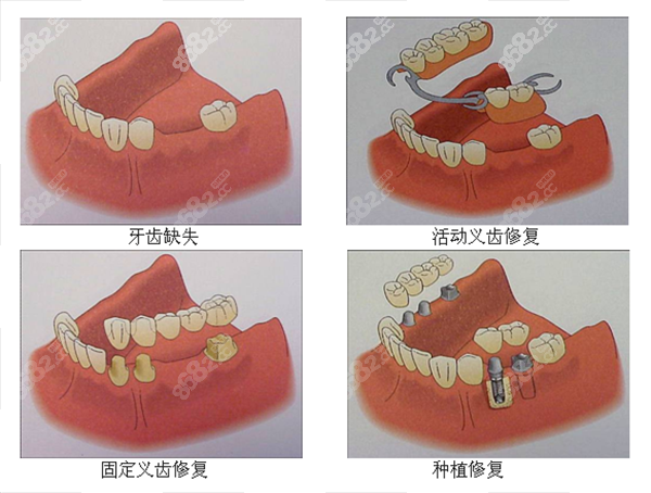 牙齿修复