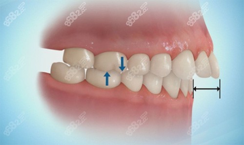 牙齿矫正深覆盖和深覆合的区别在哪?
