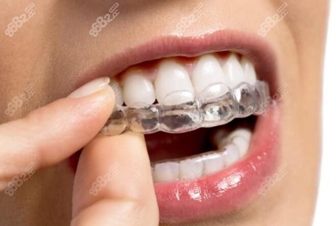 2023牙齿矫正价格表 2023牙齿矫正价格表