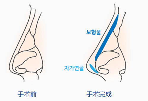 韩国环球鼻部整形手术