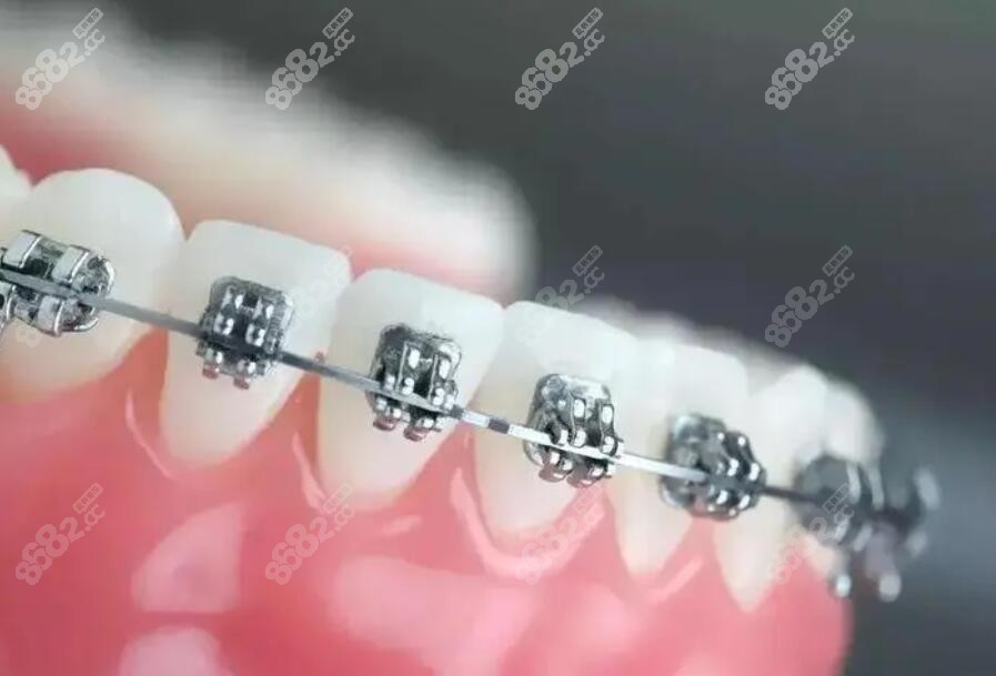 2023金属托槽矫正价格表 2023金属托槽矫正价格表