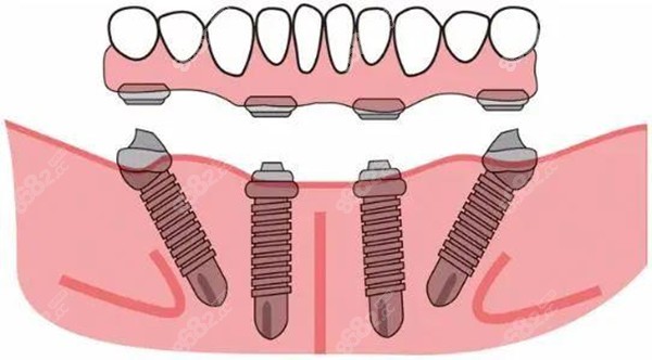 福州维乐口腔全口种植牙价格8682.cc