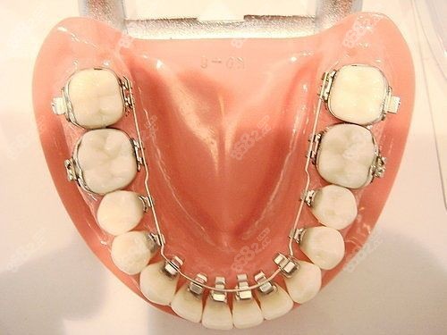 舌侧矫正价格表 舌侧矫正价格表