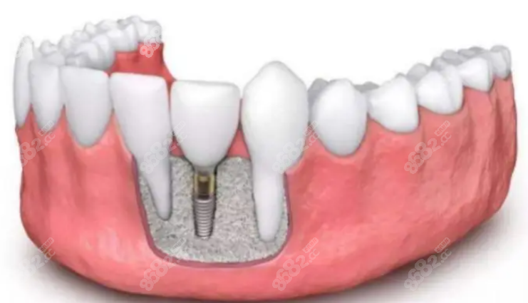 种植牙医院