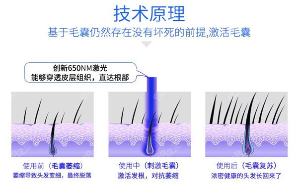 除了植发激光生发技术比较有效