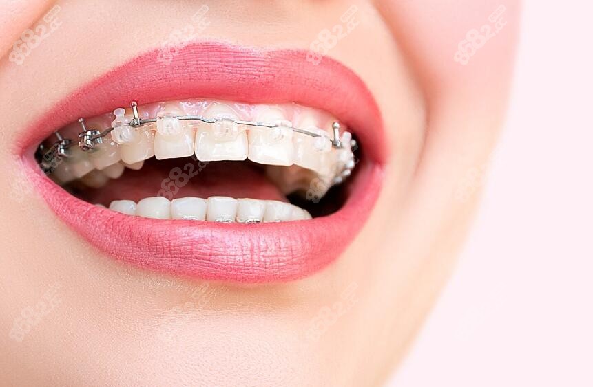 陶瓷半隐形矫正价格表 陶瓷半隐形矫正价格表