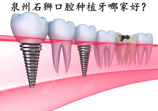 泉州石狮种植牙哪家比较好