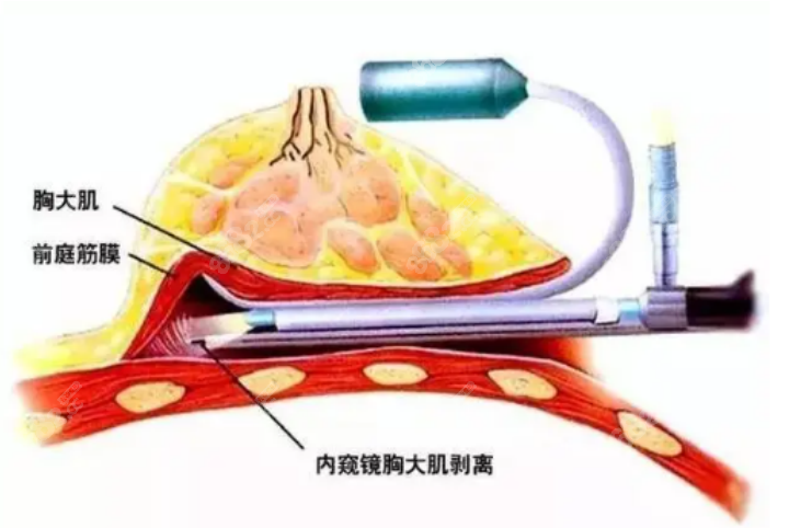 深圳哪个隆胸医生好预约