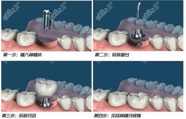 种植牙流程调控目标落实到位