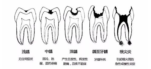 龋齿发展过程