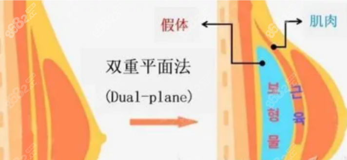 深圳隆胸手术