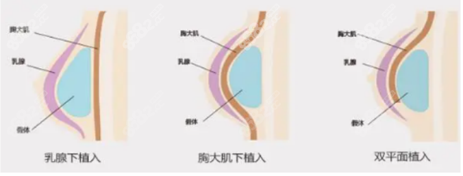 假体隆胸手术