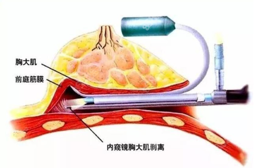 内窥镜假体隆胸优势8682.cc