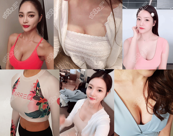 韩国dream梦想整形医院假体隆胸前后对比照片