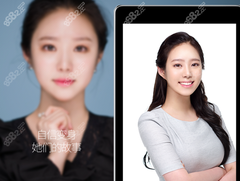 韩国梦想整形医院假体隆胸前后对比照片