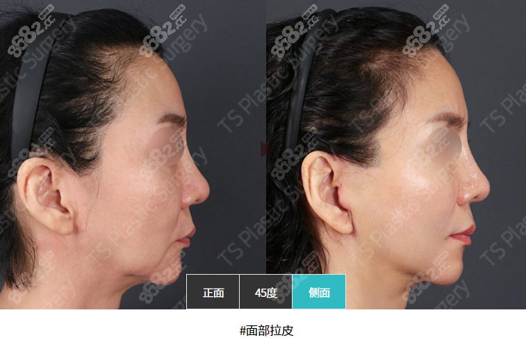 韩国TS整形外科医院面部拉皮除皱前后对比图