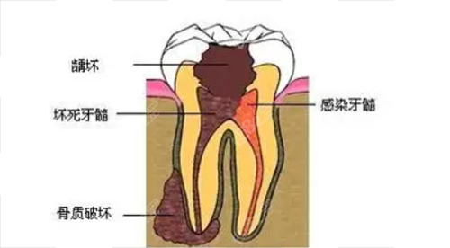 牙髓炎