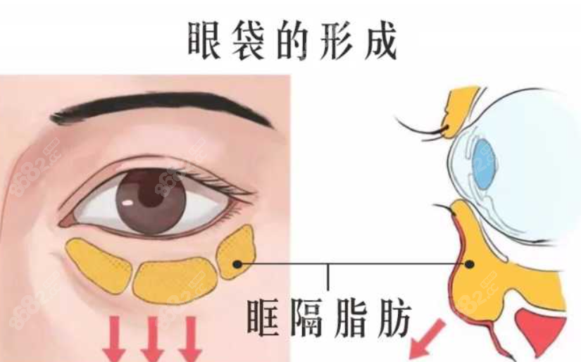 合肥维多利亚去眼袋怎么样