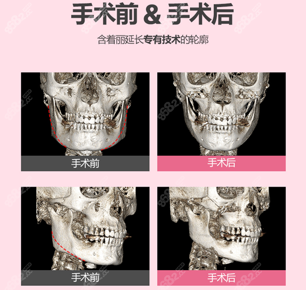 韩国丽延长下颌角整形手术例子