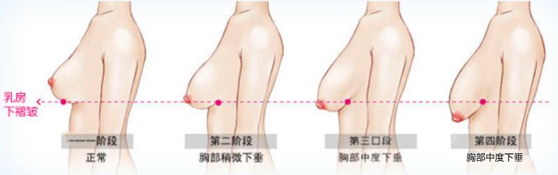 乳房下垂程度8682.cc