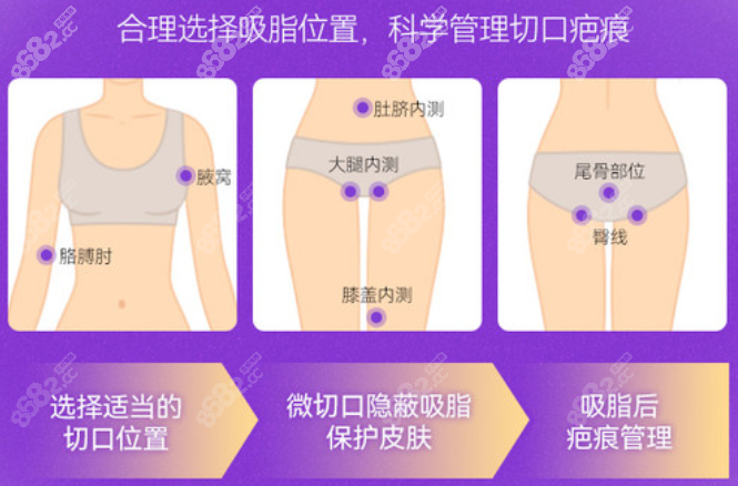 杭州薇琳吸脂医生哪个好