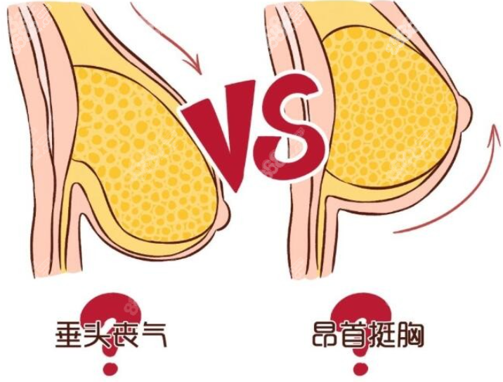 乳房下垂矫正