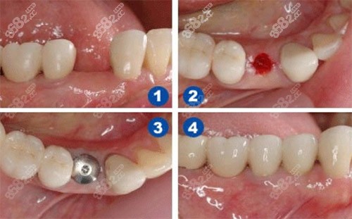 微创种植牙手术过程