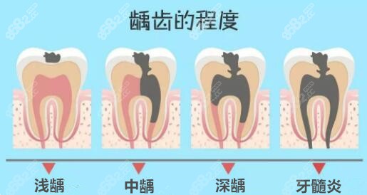 牙齿冷热刺激痛什么原因龋坏m.8682.cc