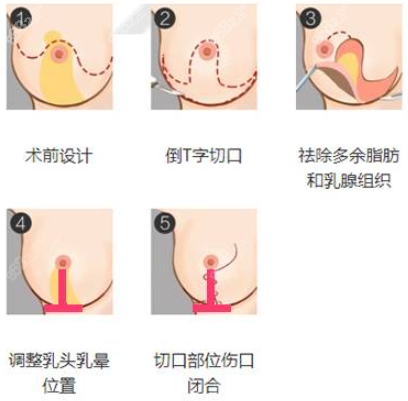 乳房下垂提升手术示意图