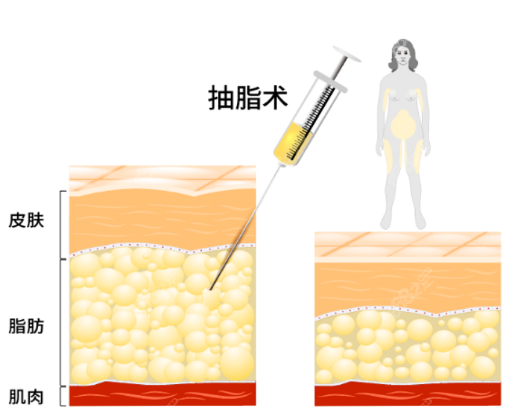 吸脂手术在线咨询医生医院