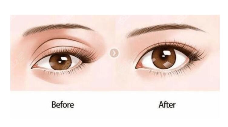 关于双眼皮手术