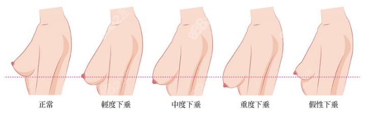 缩胸手术一般多少钱