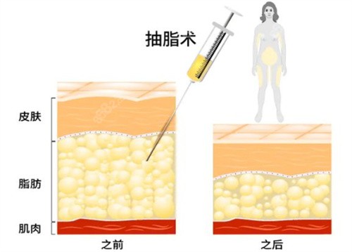 北京王志军医生抽脂价格多少钱？