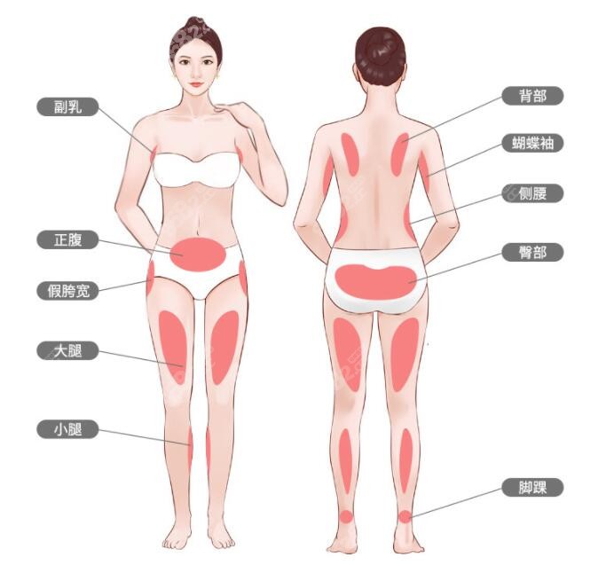 国内技术成熟的吸脂医院可开展全身吸脂
