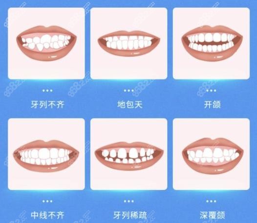乐清儿童牙齿正畸多少钱