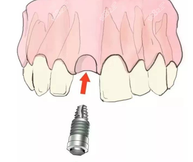 全口种植牙要打几颗钉www.8682.cc